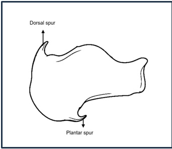 Schematic illustration of calcaneal spurs