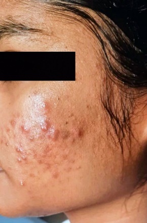 Pcos Skin Rash Association of Polycystic Ovary Syndrome (PCOS) with Acne Vulgaris: An ...