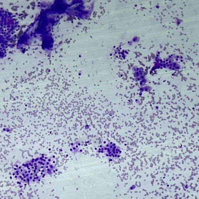 Correlation Using Excel Clinicopathological and Radiological profile of various superficial ...