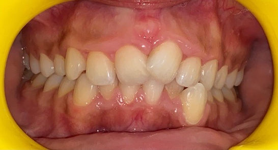 In occlusion frontal photograph of the participant.