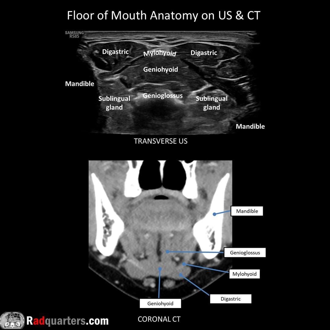 Ultrasound image of floor of the mouth showing muscles of floor of the mouth.