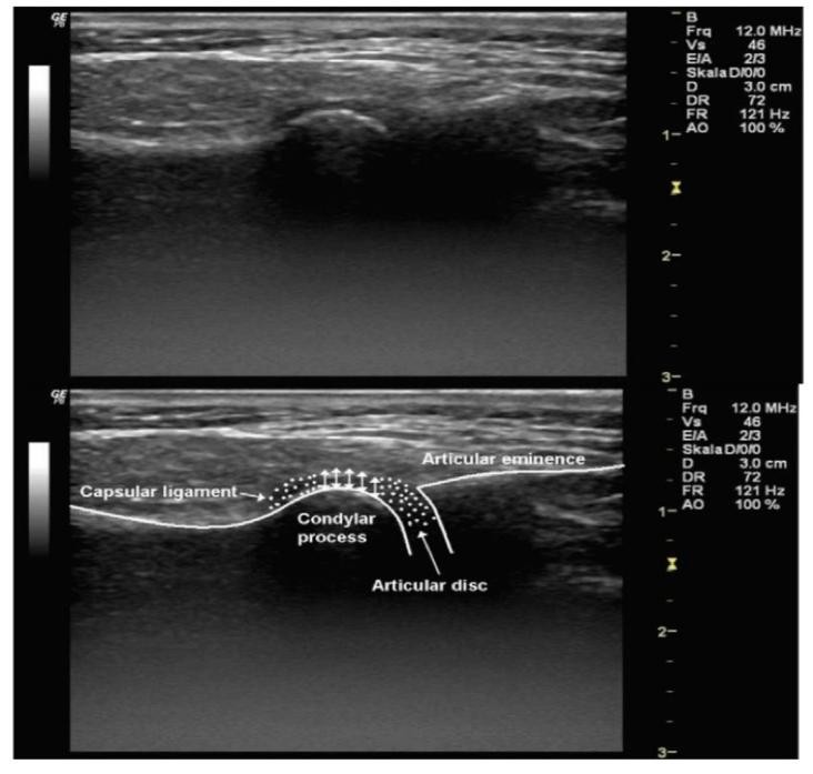Ultrasound image showing anatomy of TMJ.