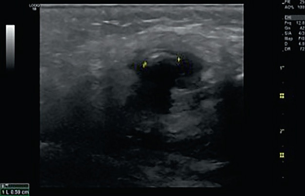 Ultrasound image of sialolithiasis of submandibular gland.