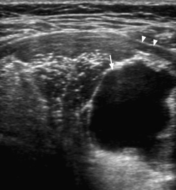 Ultrasound image of ranula.