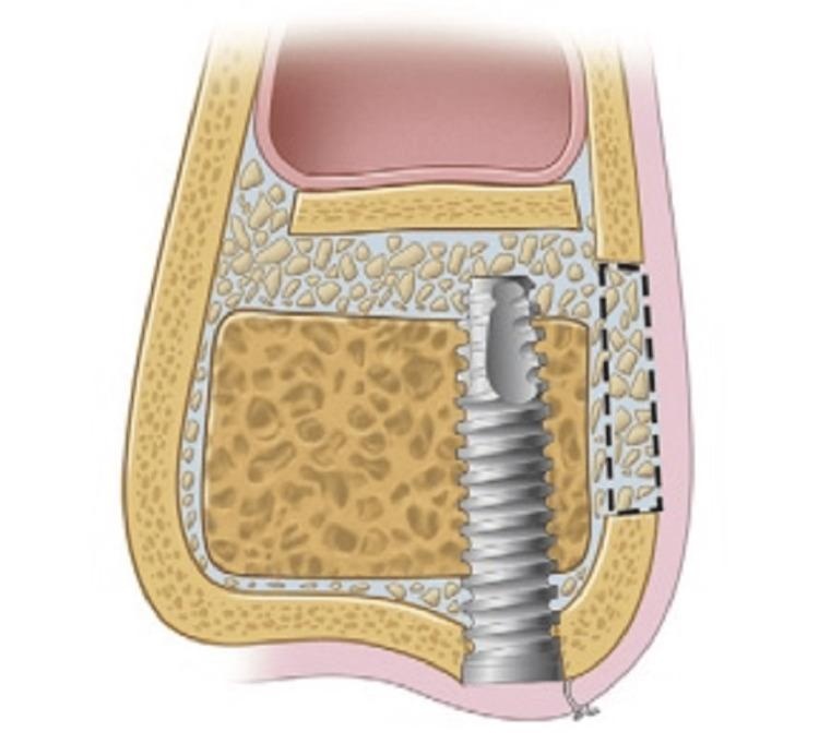 Cross-sectional representation of sinus floor elevation with simultaneous dental implant placement. Elevation of the Schneiderian membrane allows augmentation of the subantral space, increasing bone volume and enabling implant rehabilitation in the atrophic posterior maxilla.