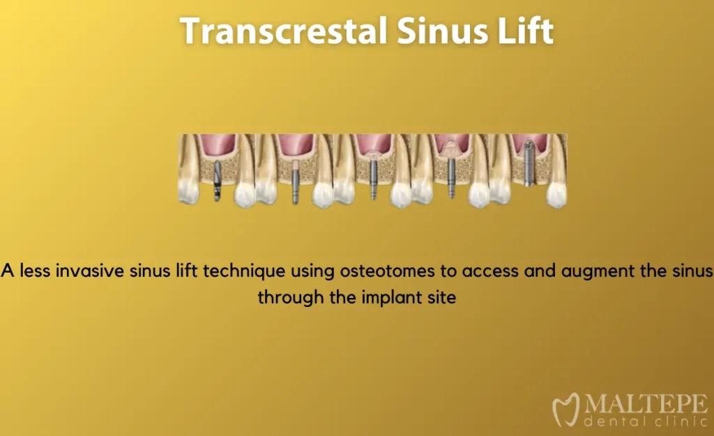 Sequential representation of the transcrestal sinus augmentation procedure. Osteotomes are used through the alveolar crest to elevate the sinus membrane and create sufficient vertical bone height for implant placement in the posterior maxilla.