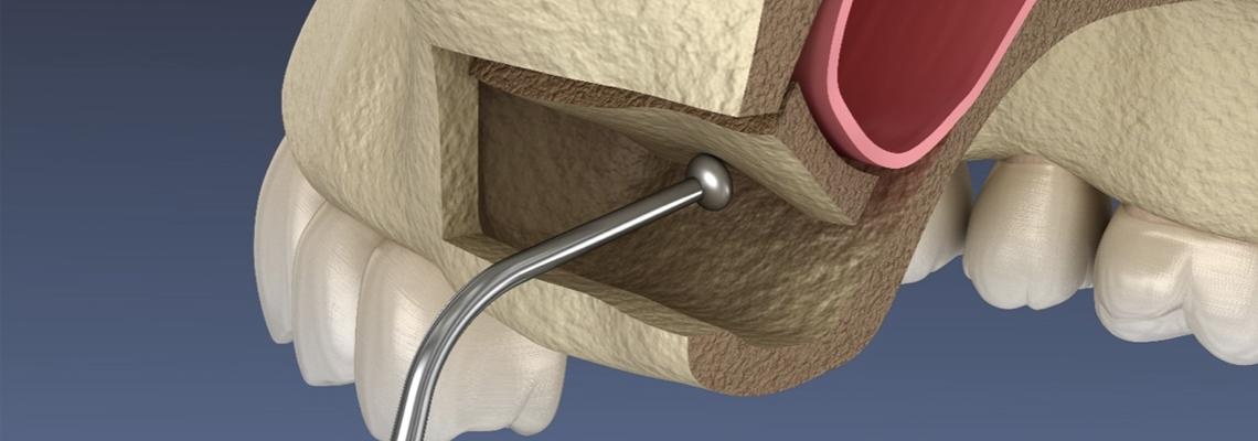 Hydraulic sinus membrane elevation technique. Elevation of the Schneiderian membrane using controlled hydraulic pressure through the osteotomy site.