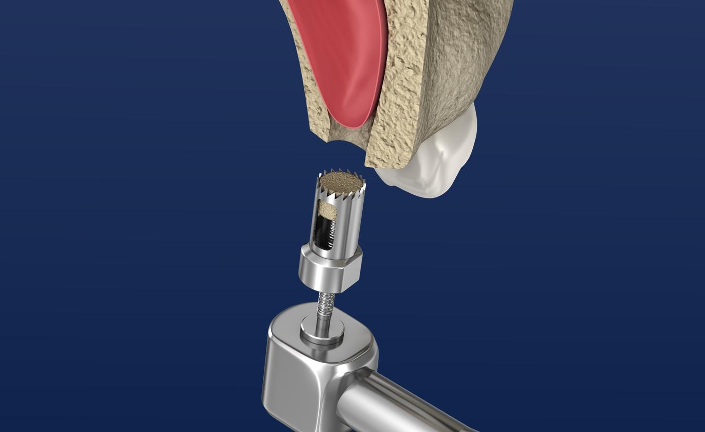 Piezoelectric sinus-lift surgery. Ultrasonic osteotomy and atraumatic sinus membrane elevation performed using piezoelectric surgical instruments.