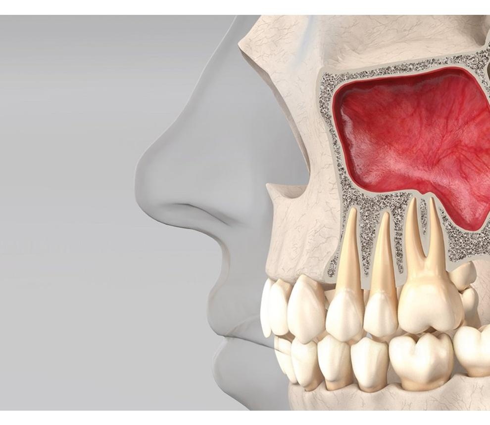 Anatomy of the maxillary sinus: Schematic representation showing the Schneiderian membrane, maxillary ostium, sinus floor, sinus septa, and posterior superior alveolar artery relevant to sinus augmentation procedures.