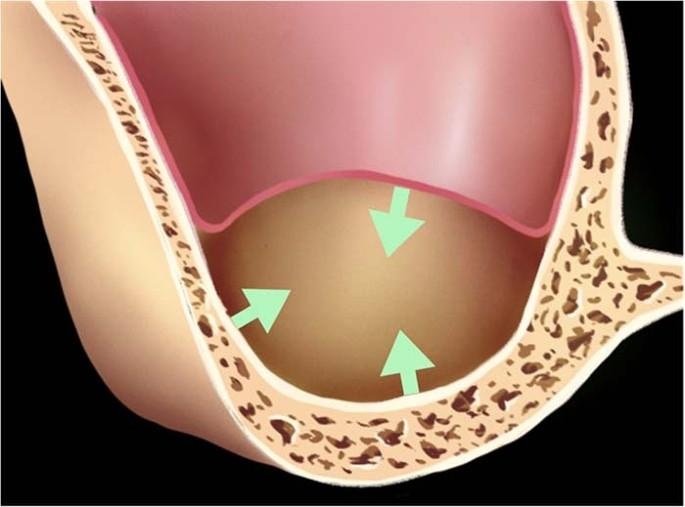Three walls of confined space over the maxillary floor: The lateral wall of the maxillary sinus, the alveolar ridge crest, and the stretched and lifted maxillary sinus membrane