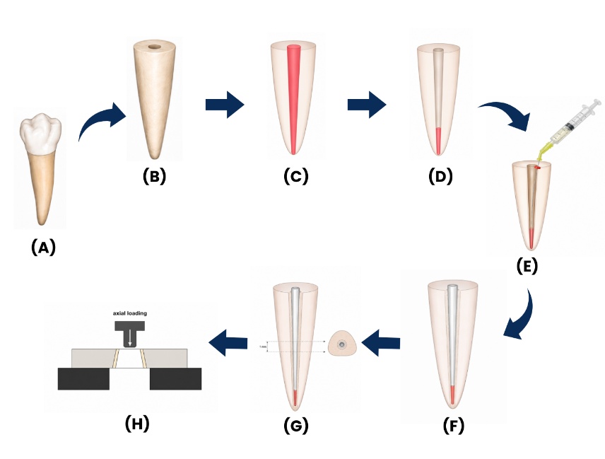 Schematic representation of specimen preparation and push-out bond strength testing of fiber post specimens. (A) Extracted mandibular premolar specimen. (B) De-coronation of tooth specimens and standardization of root length. (C) Root canal preparation and obturation using gutta-percha. (D) Post space preparation. (E) Application of dentin pretreatment agents within the post space, followed by rinsing and drying. (F) Cementation of fiber posts using resin cement. (G) Sectioning of root specimens from the middle third perpendicular to the long axis to obtain standardized slices for push-out testing. (H) Push-out bond strength testing with axial loading applied in an apico-coronal direction.