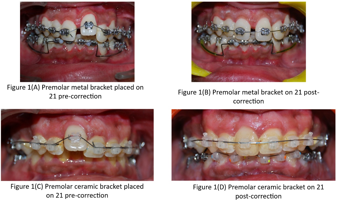 Lower premolar bracket on upper incisor.