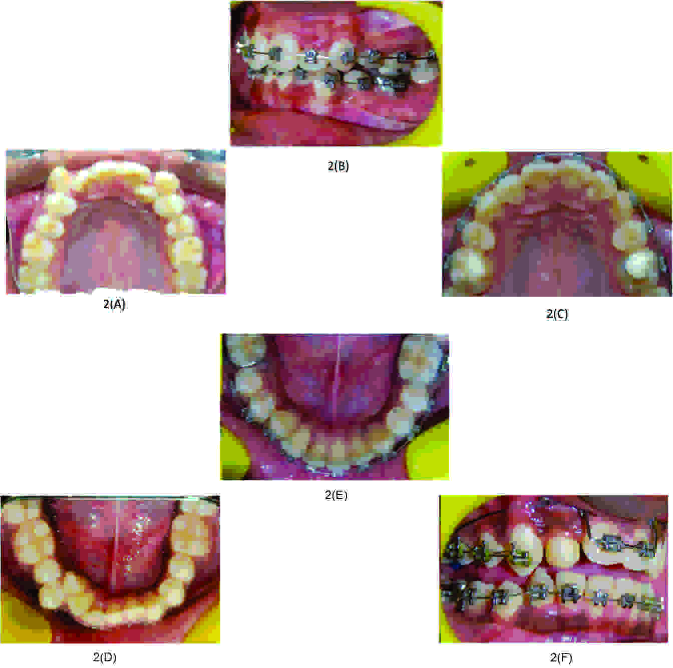 (A) Pre-treatment, (B) Lower second premolar bracket on upper lateral incisor of contralateral side, (C) Post-treatment, (d) Pre-treatment, (E) Lower first premolar bracket on lower incisor and second premolar bracket on canine of same side, (F) Post-treatment.